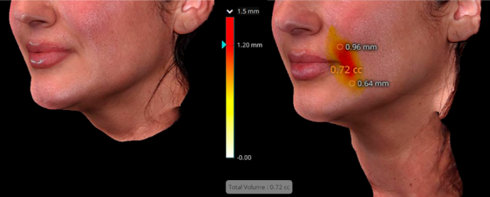 ezgel-volume-3d-before-and-after-1