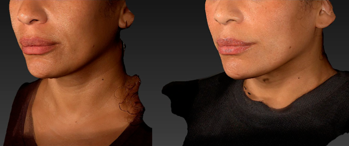 ezgel-volume-3d-before-and-after-2