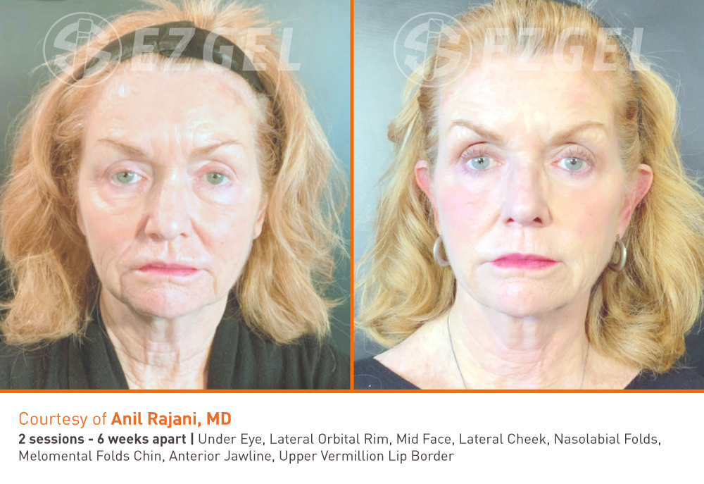 ezgel-before-and-after-6