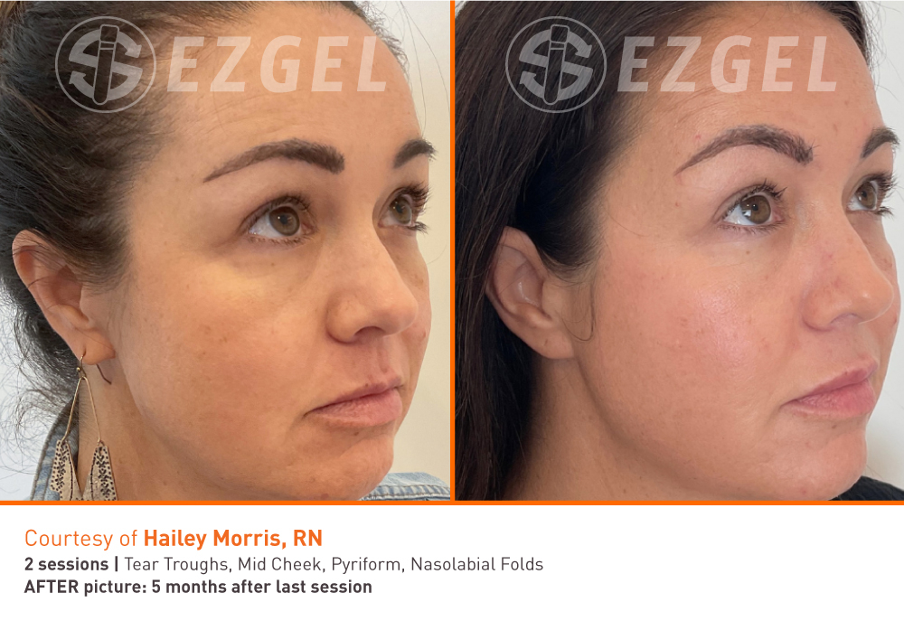 ezgel-before-and-after-11