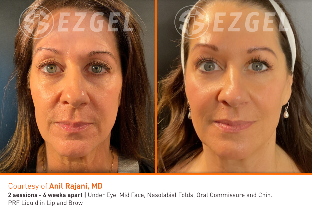 ezgel-before-and-after-7
