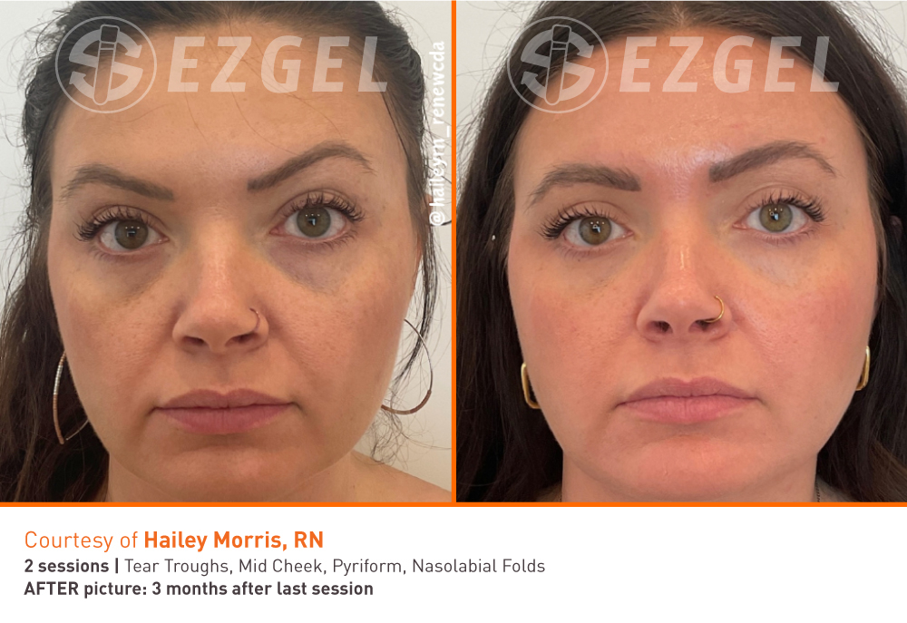 ezgel-before-and-after-1