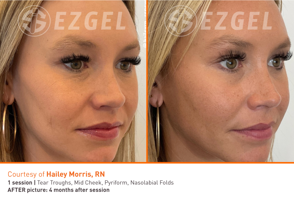 ezgel-before-and-after-10