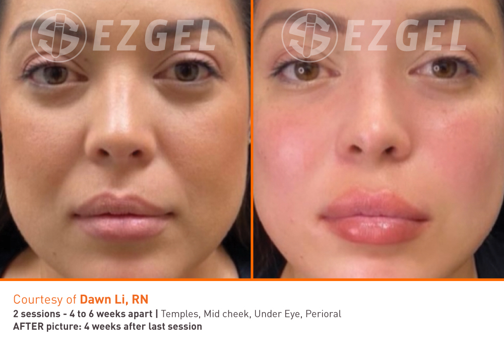 ezgel-before-and-after-3