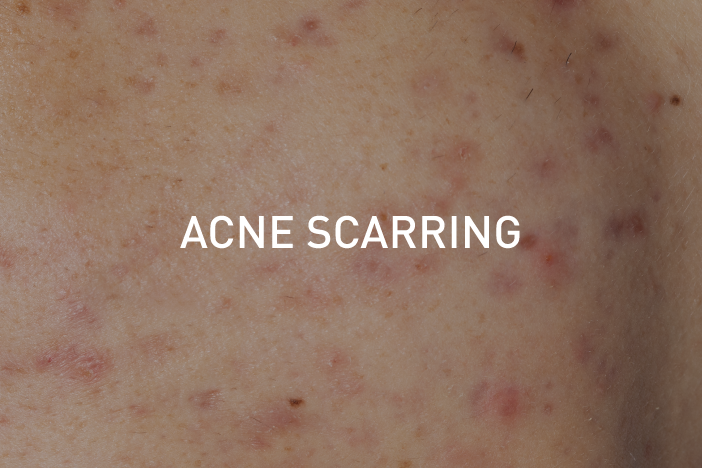 acne-scarring
