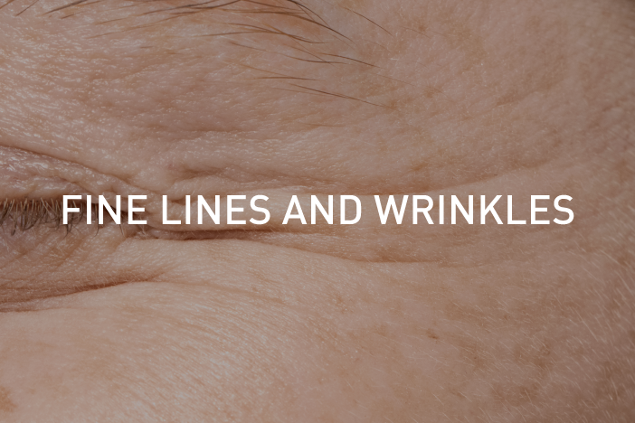 fine-lines-and-wrinkles