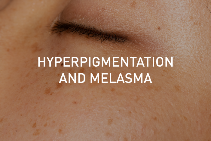 hyperpigmentation-and-melasma
