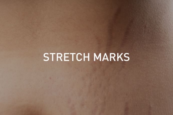 stretch-marks